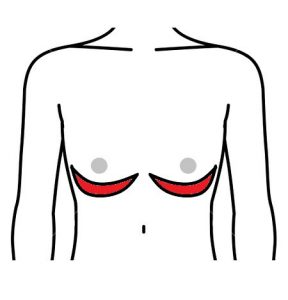 女性化乳房 乳房下切開法