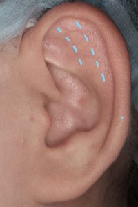 耳介形成１ 術前イメージ