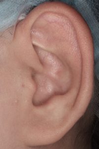 耳介形成１ 術前左１