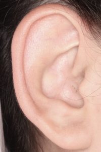 耳介形成１ 術前右１