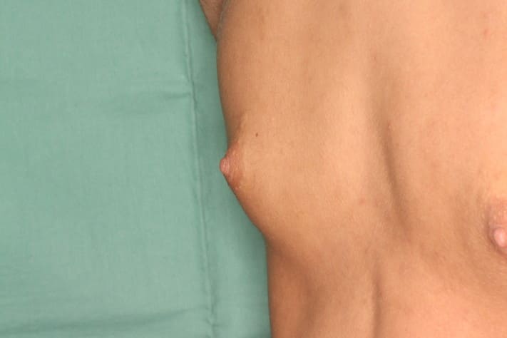 女性化乳房１ 術前３