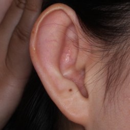 耳介形成術２術前１