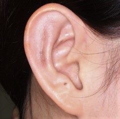 耳介形成術２術後１