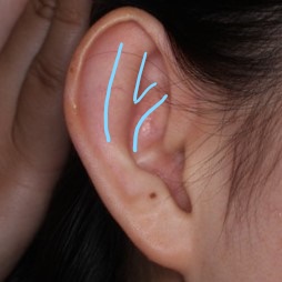 耳介形成術２design