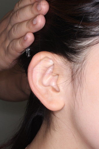 耳介形成術３術前１