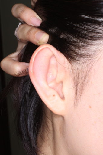 耳介形成術２術前２