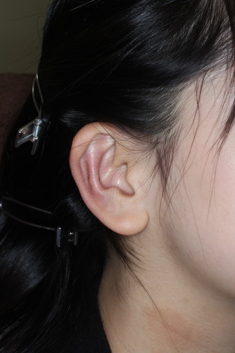 耳介形成術３術後