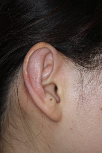 耳介形成術２術後２
