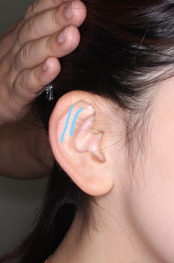 耳介形成術３術前２