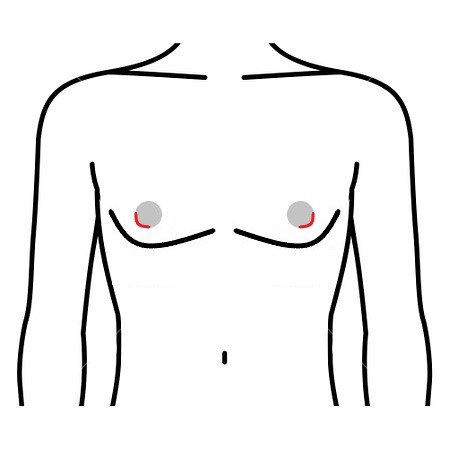 女性化乳房 乳輪下切開法