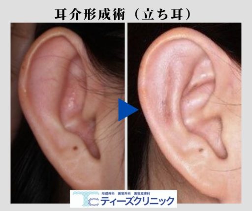 耳介形成手術　立ち耳