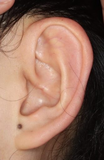 耳介形成4　術後　耳正面