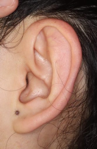 耳介形成4　術後　耳横