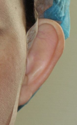 耳介形成4　術前　顔正面