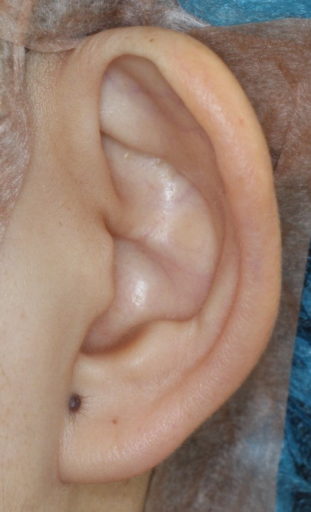 耳介形成4　術前　耳正面