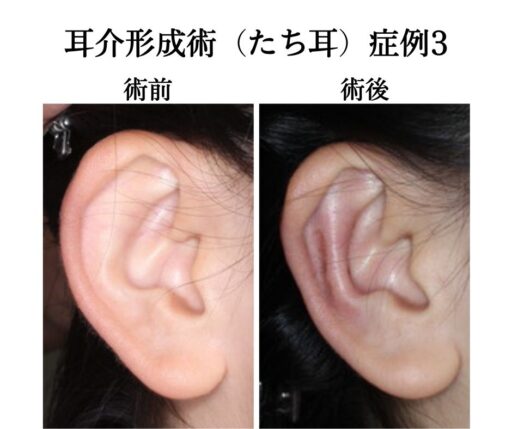 耳介形成術（たち耳）症例3