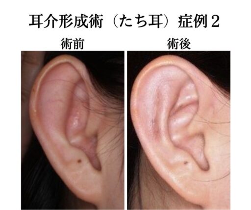 耳介形成術（たち耳）症例2
