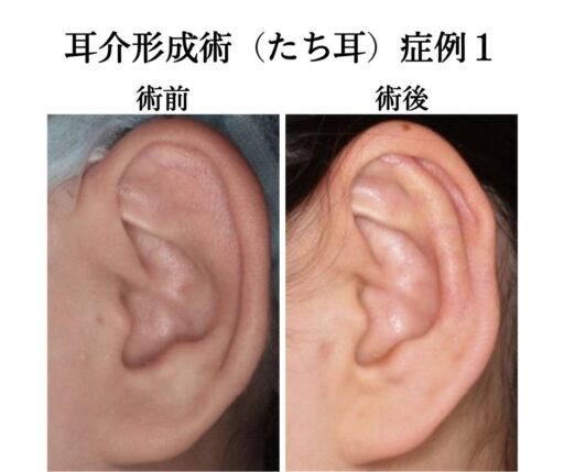 耳介形成術（たち耳）症例１