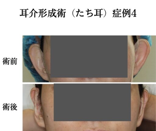 耳介形成術（たち耳）症例4
