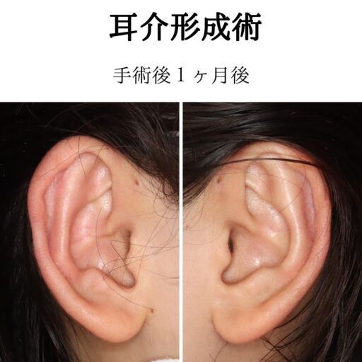立ち耳手術症例６_術後１ヶ月