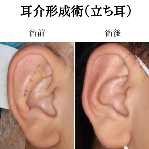 立ち耳手術症例５_術前術後
