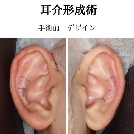 立ち耳手術症例6_術前デザイン