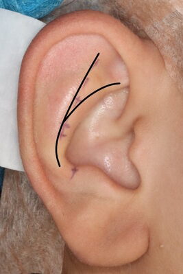 立ち耳手術症例６耳輪脚