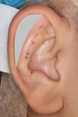 立ち耳手術症例６舟状窩