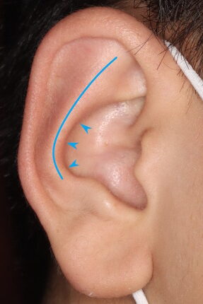 立ち耳手術症例６説明図